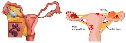 Prise en charge endométrioses - Centre gynécologie Aubagne