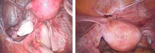 échographie endovaginale