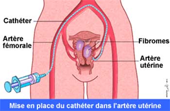 Chirurgie gynecologique, Prise en charge des fibromes